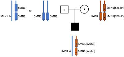 A homozygous missense variant in the YG box domain in an individual with severe spinal muscular atrophy: a case report and variant characterization